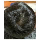 頭皮ハゲ改善されてる