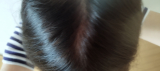 「抜け毛がひどく､このままでは､カツラかと心配していました。」の画像（1枚目）