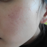 肌の赤みと毛穴