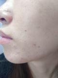 シミニキビ跡