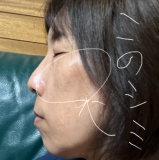 頬のシミがヤバい