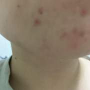 「ニキビとニキビあと」【発売前先行モニター♡】シミ・色むらお悩みの方！ハイドロキノン配合コンシーラー　先行モニター　の投稿画像