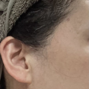 「こめかみ」【発売前先行モニター♡】シミ・色むらお悩みの方！ハイドロキノン配合コンシーラー　先行モニター　の投稿画像