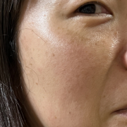 「シミ」【発売前先行モニター♡】シミ・色むらお悩みの方！ハイドロキノン配合コンシーラー　先行モニター　の投稿画像