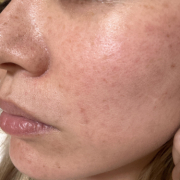 「初めまして」【発売前先行モニター♡】シミ・色むらお悩みの方！ハイドロキノン配合コンシーラー　先行モニター　の投稿画像