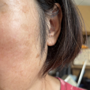 「シミだか色斑だか区別できません」【発売前先行モニター♡】シミ・色むらお悩みの方！ハイドロキノン配合コンシーラー　先行モニター　の投稿画像