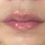 肺炎になってお手入れなんて全くできず、やばかった唇&hellip;子どもの発表会があって藁にもすがる思いでリップショットを使いました！ニードルは全然痛くないし美容液沢山入ってるしプルプルになりました！置いとく&hellip;のInstagram画像
