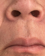 #PR #テンスター #鼻毛 #脱毛 #ムダ毛処理 #鼻毛脱毛 #ワックス #monipla #tenstar_fanあまり変わらなかったのInstagram画像