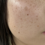 「大きなシミとそばかす？肝斑？が気になります」【現品モニター♡】シミ・でお悩みの方大歓迎！長期でモニターいただける方大募集♪の投稿画像