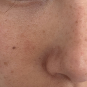 「鼻と頬が気になります」【現品モニター♡】シミ・でお悩みの方大歓迎！長期でモニターいただける方大募集♪の投稿画像