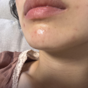 「最近荒れてきたニキビ」シミキールナイトバームの&rdquo;発売前先行モニター&rdquo;募集♡の投稿画像