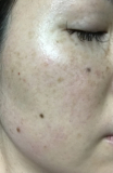 頬のシミそばかすやニキビ跡