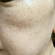 「頬に無数のシミ(；´Д`A」シミキールナイトバームの&rdquo;発売前先行モニター&rdquo;募集♡の投稿画像