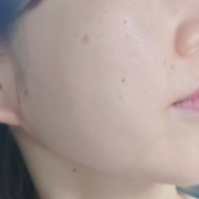 「頬のシミ、毛穴、気になります。」シミキールナイトバームの&rdquo;発売前先行モニター&rdquo;募集♡の投稿画像