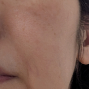 「頬のシミの様子」シミキールナイトバームの&rdquo;発売前先行モニター&rdquo;募集♡の投稿画像