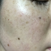 「頬のシミそばかすやニキビ跡」シミキールナイトバームの&rdquo;発売前先行モニター&rdquo;募集♡の投稿画像