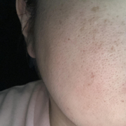 「シミシワ、ニキビ跡が気になります。」【先行モニター】&rdquo;発売前先行モニター&rdquo;募集♡の投稿画像