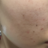 ニキビ跡とニキビ