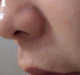 小鼻のワキの赤み、ほほのシミ