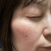 「シミと赤みが気になります。」【限定20名！現品モニター】新商品を現品でお届け♪ 使ってみた感想をInstagramに投稿してくれる方募集♡の投稿画像