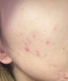 戦いは続く、ほっぺニキビの逆襲