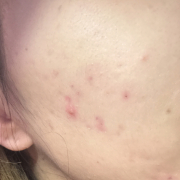 「戦いは続く、ほっぺニキビの逆襲」【限定20名！現品モニター】新商品を現品でお届け♪ 使ってみた感想をInstagramに投稿してくれる方募集♡の投稿画像