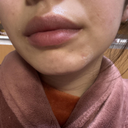 「ニキビ跡」【限定20名！現品モニター】新商品を現品でお届け♪ 使ってみた感想をInstagramに投稿してくれる方募集♡の投稿画像