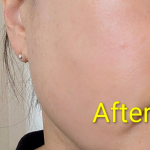 toiroバイタライジングのトライアルセット。使い続けた肌の様子です。どちらも素っぴんですが調子良く感じます。赤みがあった肌も落ち着き保湿力もアップした感じです。私の肌に合ってるんだなぁ〜とい&hellip;のInstagram画像