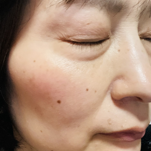 頬の赤み、鼻まわりの毛穴