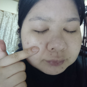 「濃いシミ部分です。」【限定20名！現品モニター】 美容液成分94％配合のピーリングバームの感想をInstagramに投稿してくれる方募集♡の投稿画像