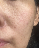 毛穴、ケガ跡の色素沈着、シミ、赤みが悩みです