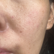 毛穴、ケガ跡の色素沈着、シミ、赤みが悩みです