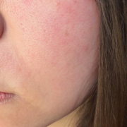 「頬の毛穴開きが気になります」【限定20名！現品モニター】 美容液成分94％配合のピーリングバームの感想をInstagramに投稿してくれる方募集♡の投稿画像