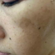 「コンシラーでも隠せないシミ（>﹏<）」【限定20名！現品モニター】 美容液成分94％配合のピーリングバームの感想をInstagramに投稿してくれる方募集♡の投稿画像