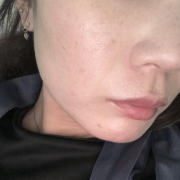 「頬のそばかす　毛穴の開き」【限定20名！現品モニター】 美容液成分94％配合のピーリングバームの感想をInstagramに投稿してくれる方募集♡の投稿画像