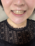 歯が黄ばんでいるのが気になっています