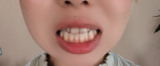 歯のくすみ・黄ばみ