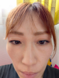 二重の上にたるみ線ができてしまっている
