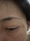 まぶたのたるみ