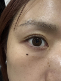 目の窪み、二重の安定