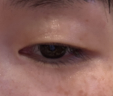二重の幅が小さくなって瞼が重たい感じ