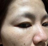 重たい二重まぶた、、