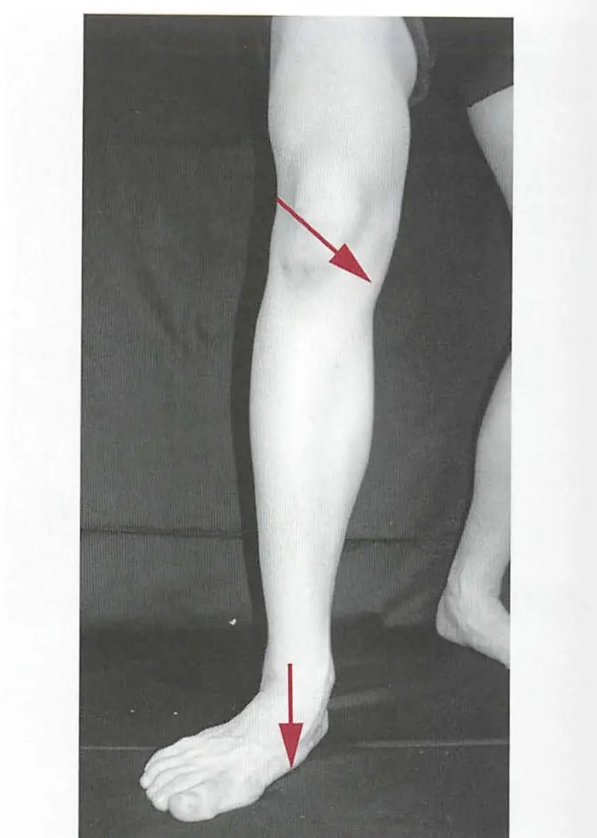 Knee in-Toe out