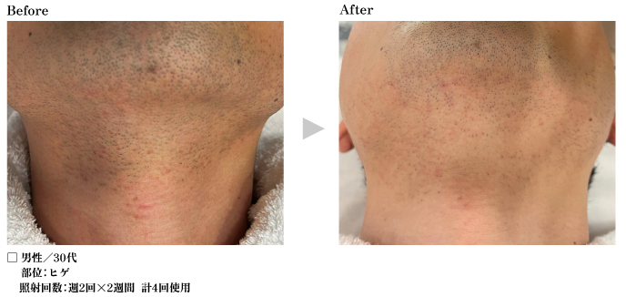 元祖脱毛サロンが積み上げたノウハウの結晶、脱毛のプロフェッショナル