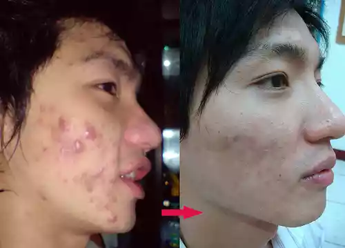 Lumi - 皮膚痘痘改善