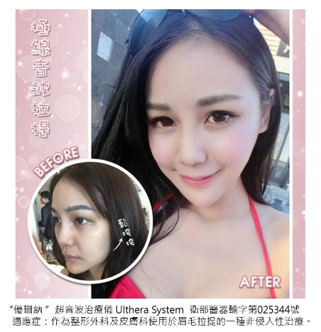 NO.1優珊納音波拉提~擺脫鬆鬆肌首選